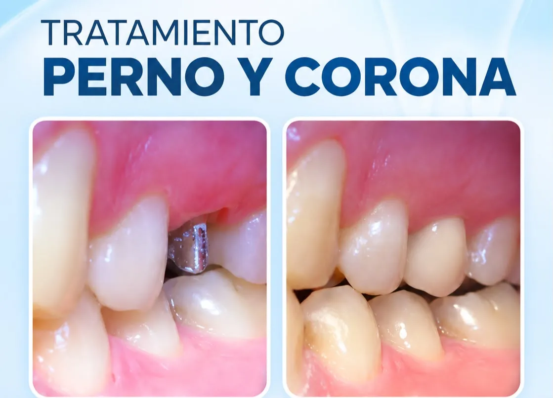 Antes y después de un tratamiento de perno y corona: perno metálico colocado y corona terminada